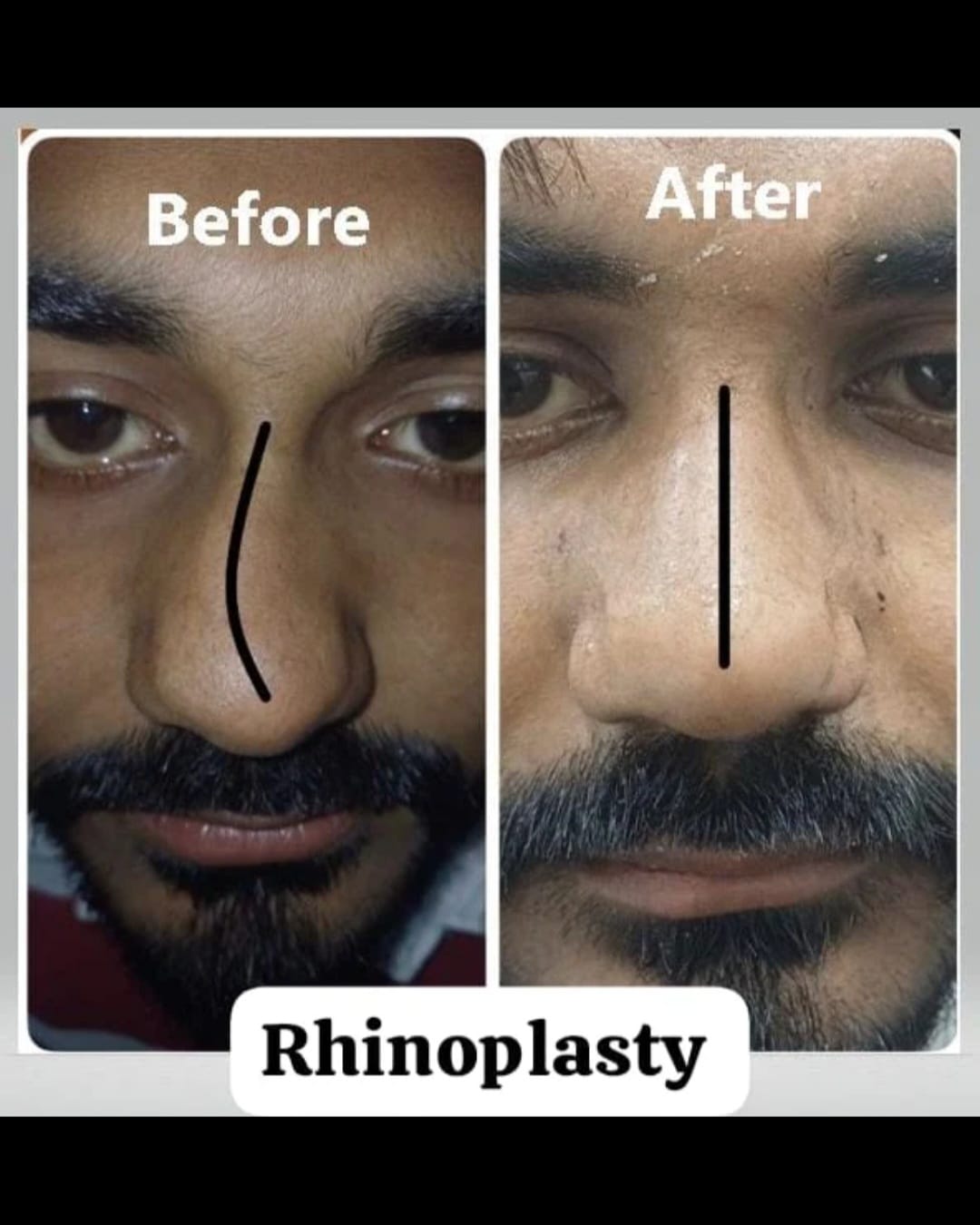 Before and after result of rhinoplasty (nasal surgery) at Ayushmaan ENT Hospital
